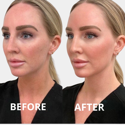 Aluxe 3D Lifting Mask