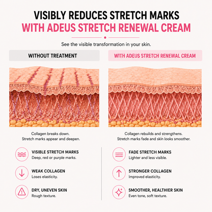 Adeus™ Stretch Renewal Cream