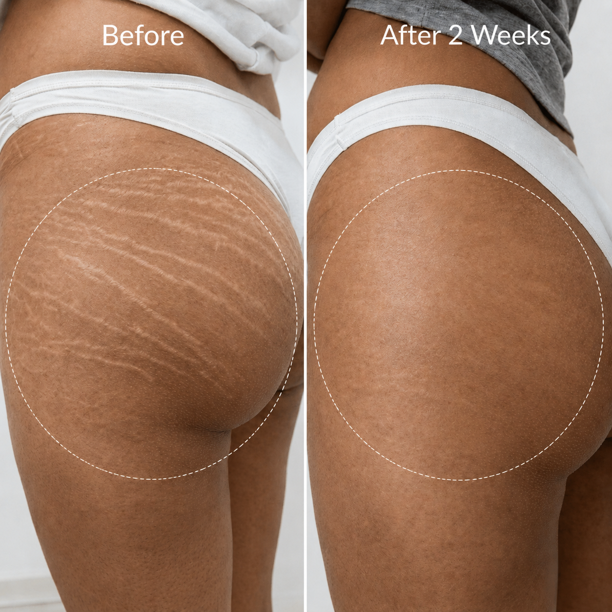Adeus™ Stretch Renewal Cream