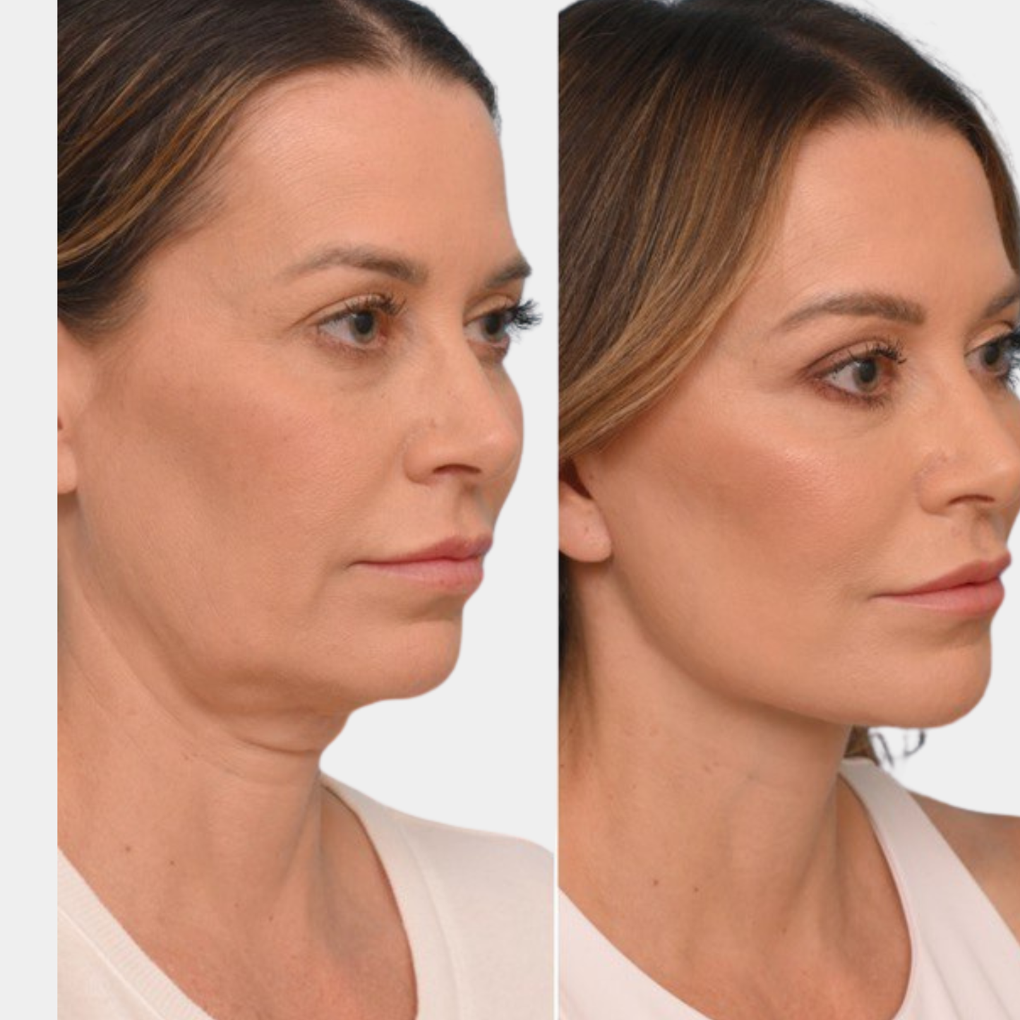 Aluxe LiftPeptide Ampoule